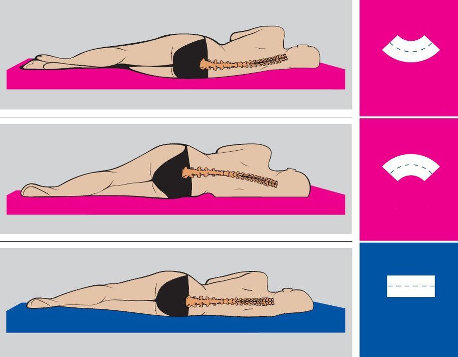 Poziția corectă a corpului în timpul somnului cu osteocondroză lombară