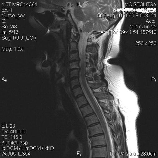 Osteochondroza și spondiloza coloanei vertebrale cervicale