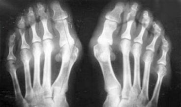Diagnosticul diferențial al simptomelor artritei și artrozei