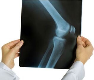 Radiografia artrozei articulației genunchiului