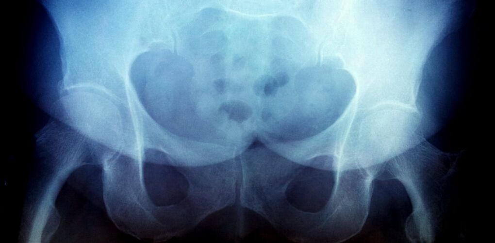 X -RAY IMAGINE CU ARTHROSIE DE GRADUL 2